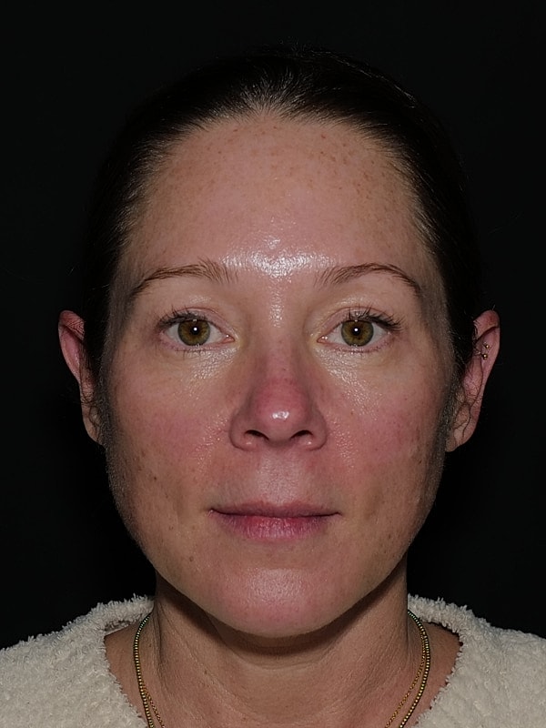 Blepharoplasty Before & After