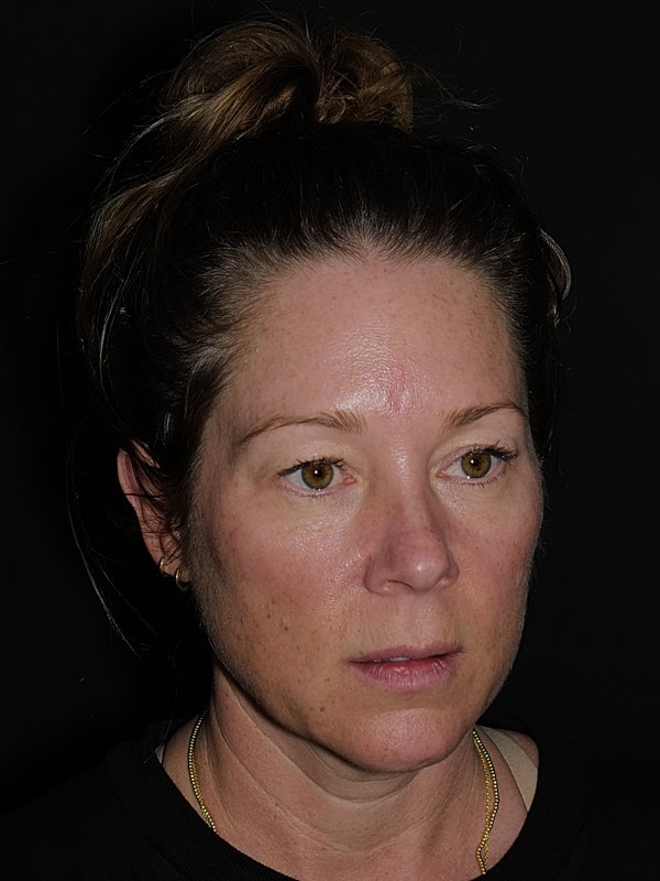 Blepharoplasty Before & After