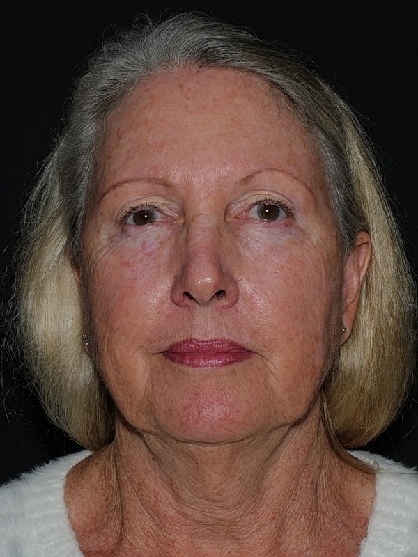 Blepharoplasty Before & After