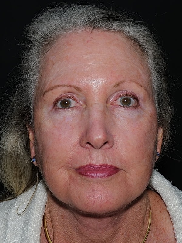 Blepharoplasty Before & After