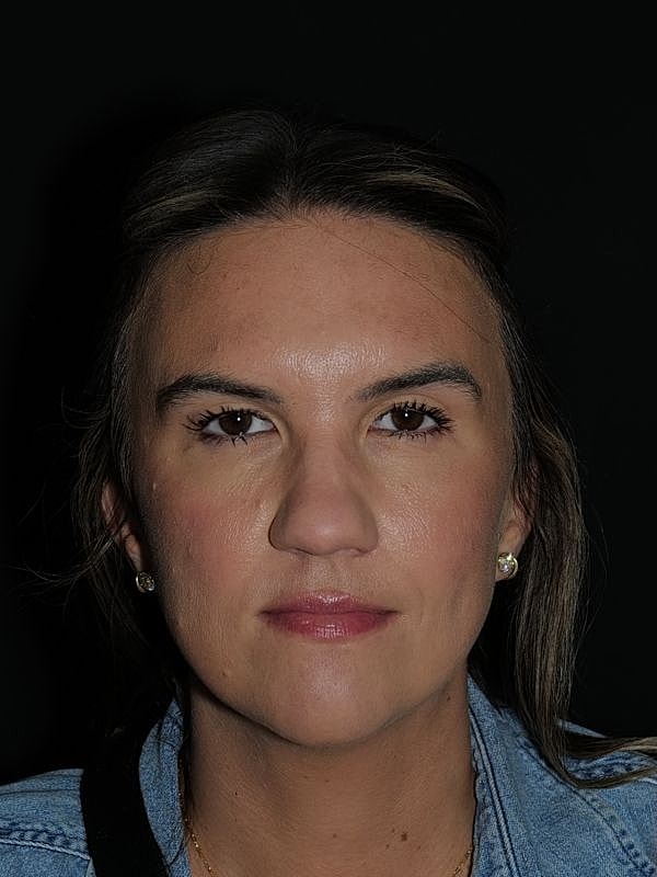 Blepharoplasty Before & After