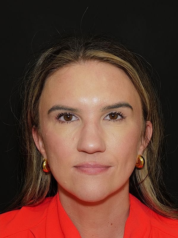 Blepharoplasty Before & After