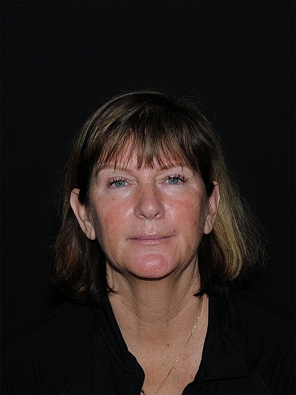 Facelift Neck Lift Before & After