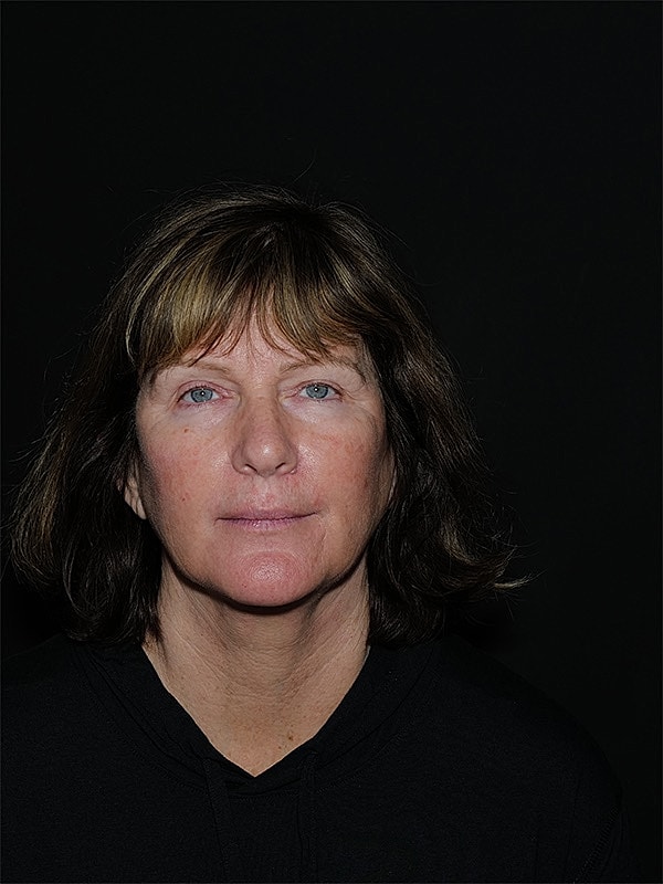 Facelift Neck Lift Before & After