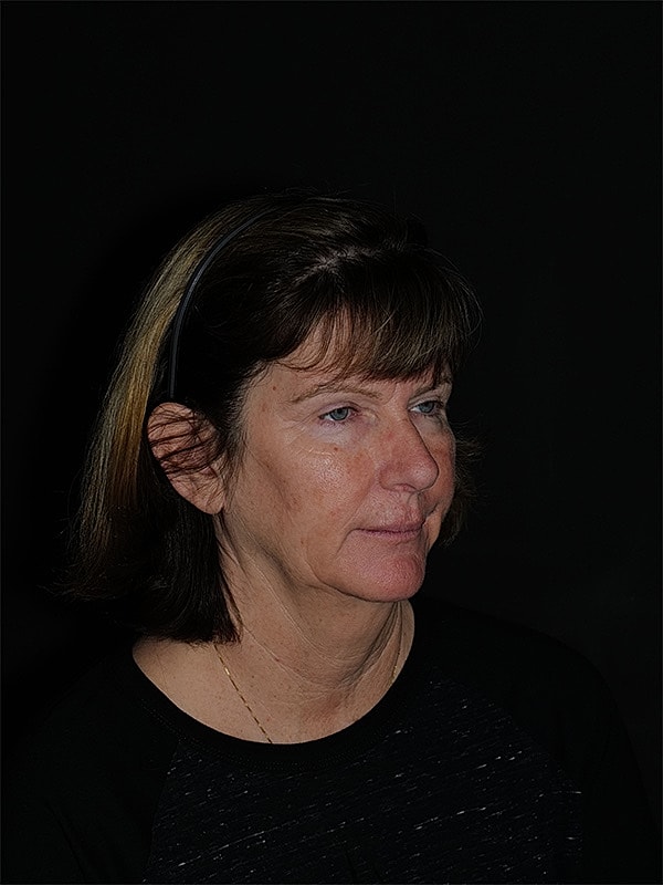 Facelift Neck Lift Before & After