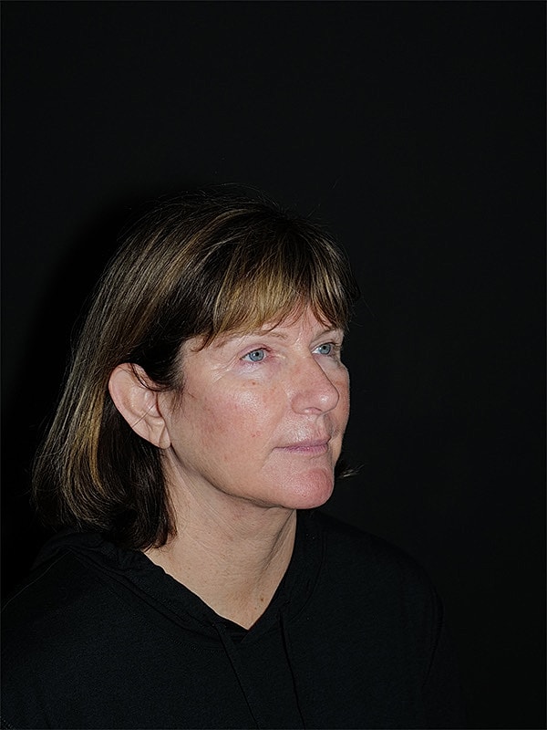 Facelift Neck Lift Before & After