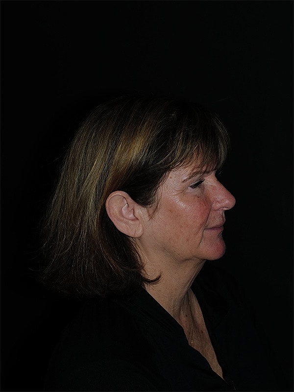 Facelift Neck Lift Before & After
