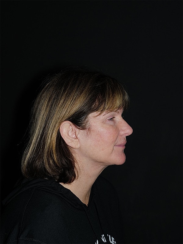 Facelift Neck Lift Before & After