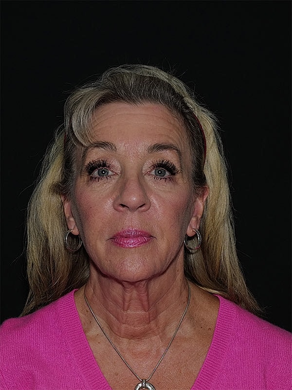 Facelift Neck Lift Before & After