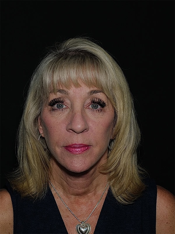 Facelift Neck Lift Before & After