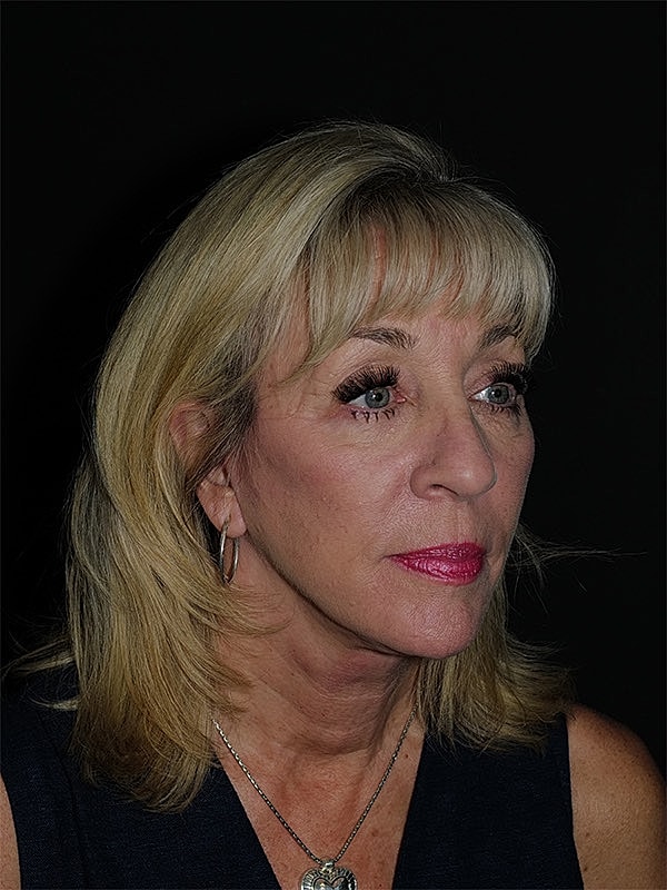 Facelift Neck Lift Before & After