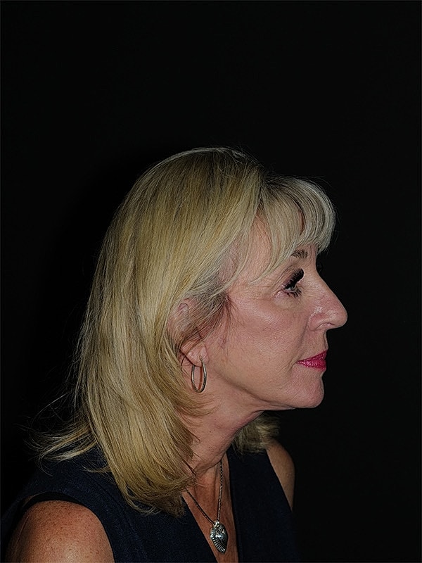 Facelift Neck Lift Before & After