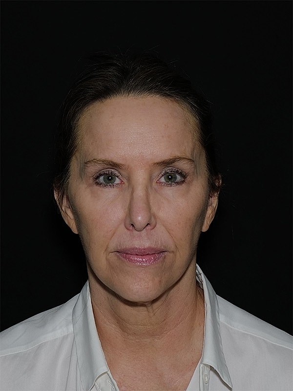Facelift Neck Lift Before & After