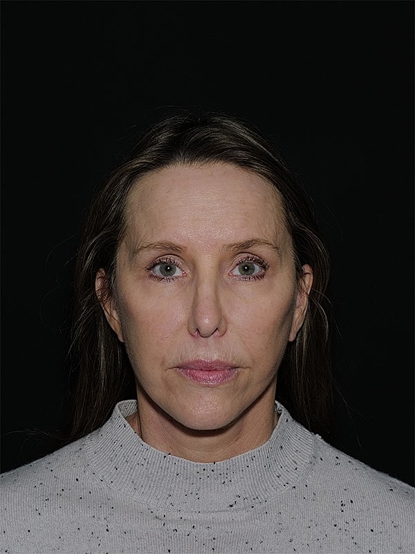 Facelift Neck Lift Before & After