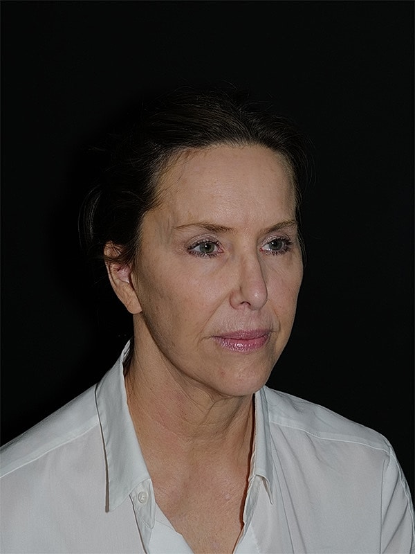 Facelift Neck Lift Before & After