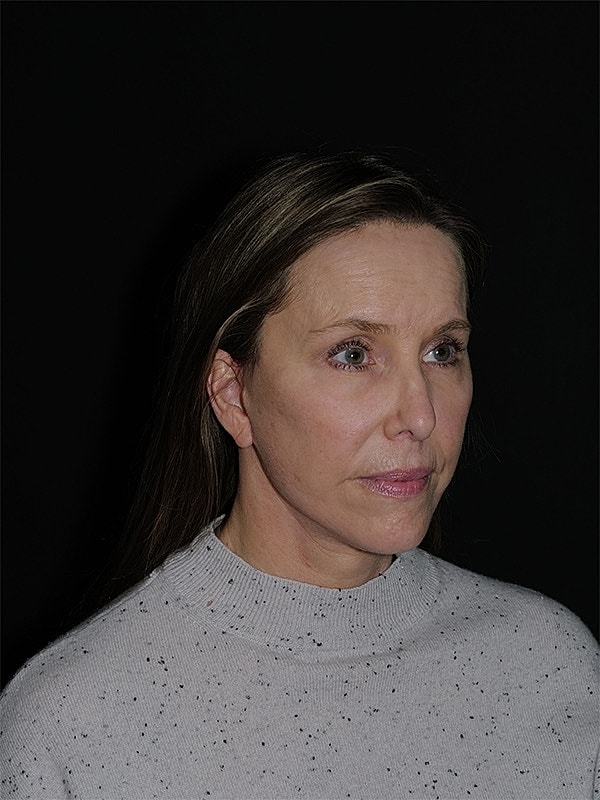 Facelift Neck Lift Before & After