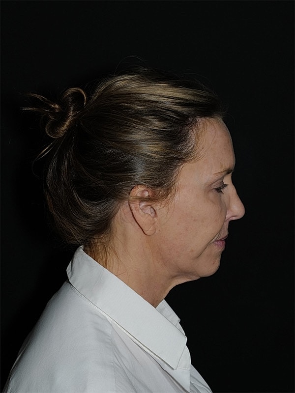 Facelift Neck Lift Before & After