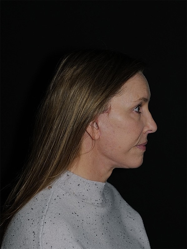 Facelift Neck Lift Before & After