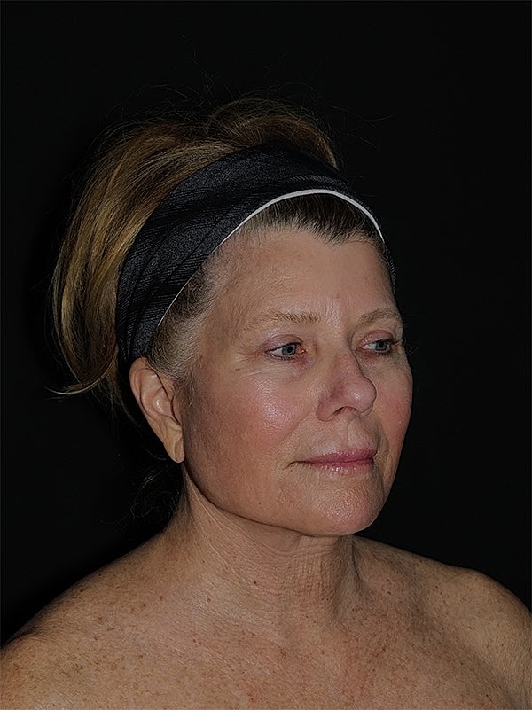 Facelift Neck Lift Before & After