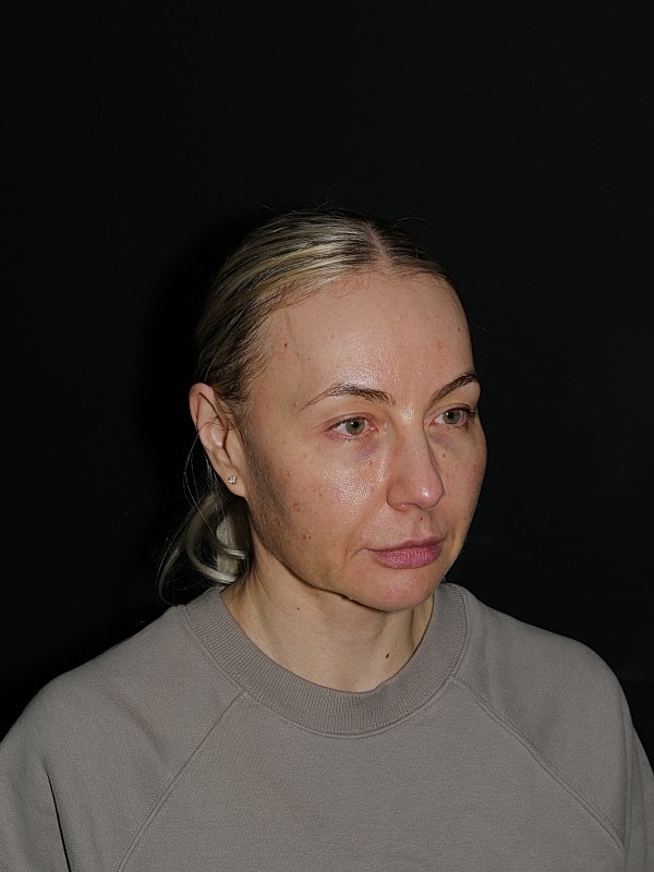 Facelift Neck Lift Before & After