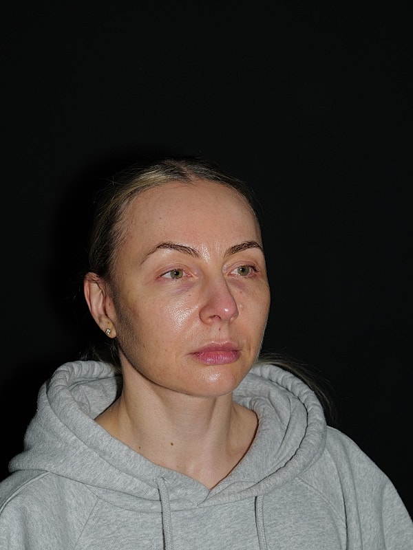 Facelift Neck Lift Before & After