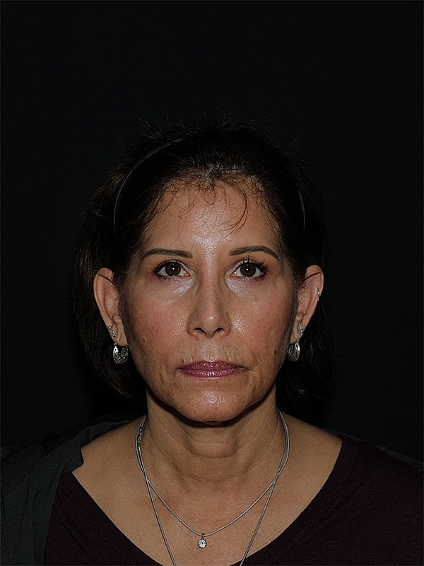 Facelift Neck Lift Before & After