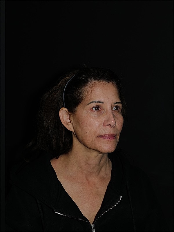Facelift Neck Lift Before & After