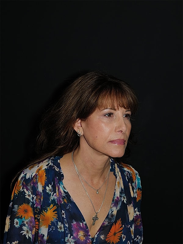 Facelift Neck Lift Before & After