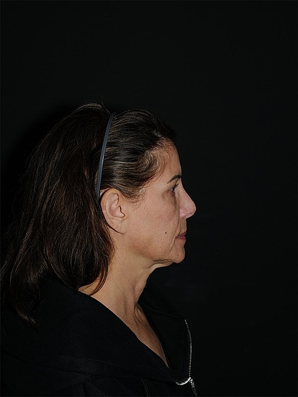 Facelift Neck Lift Before & After
