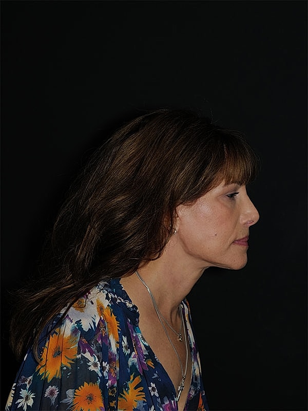 Facelift Neck Lift Before & After