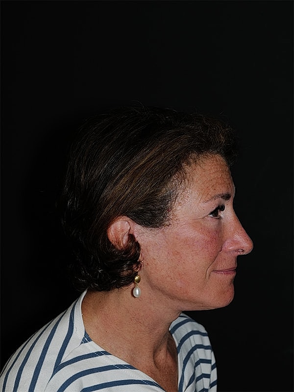 Facelift Neck Lift Before & After