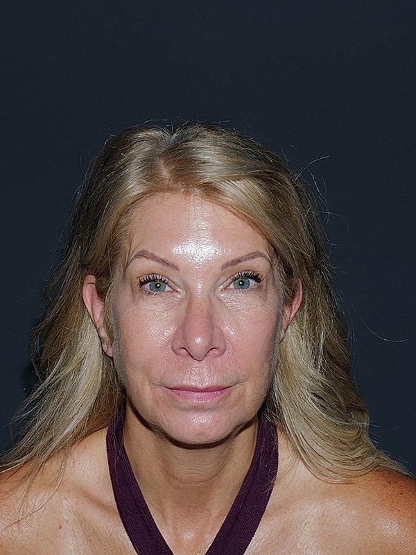 Facelift Neck Lift Before & After