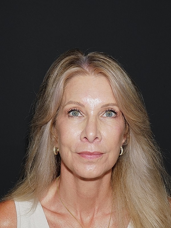 Facelift Neck Lift Before & After