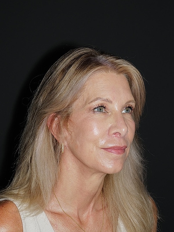 Facelift Neck Lift Before & After