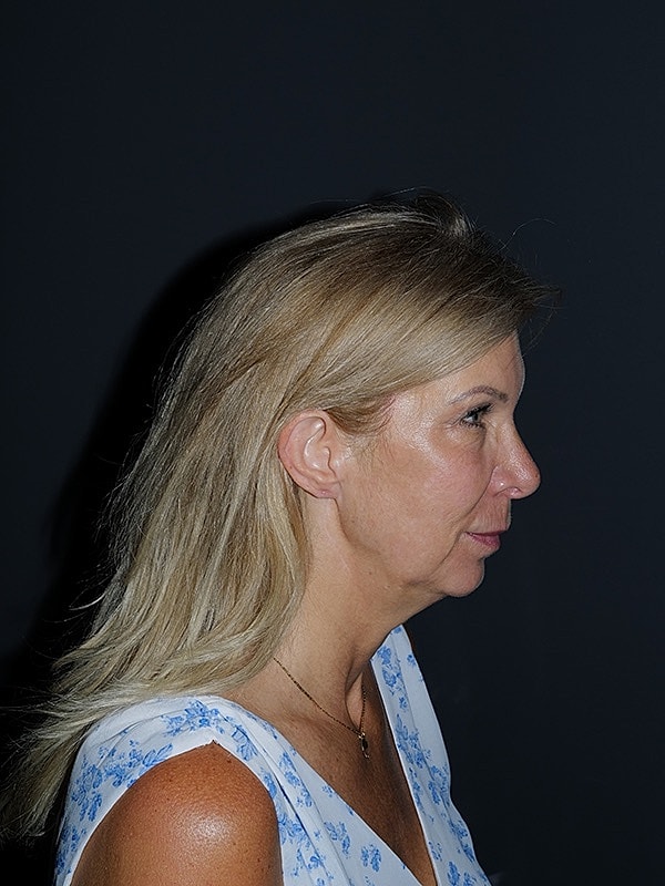 Facelift Neck Lift Before & After
