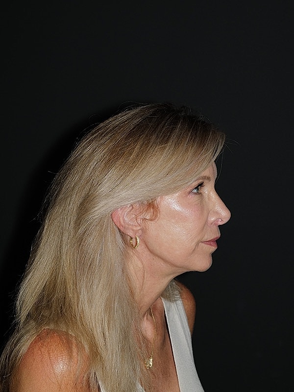 Facelift Neck Lift Before & After