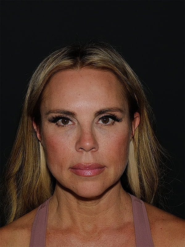 Facelift Neck Lift Before & After