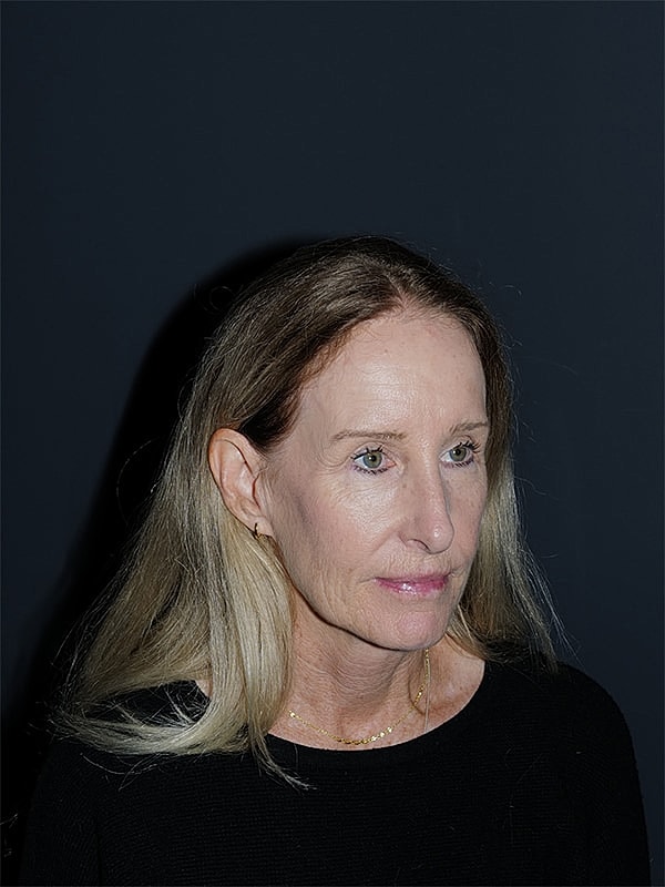 Facelift Neck Lift Before & After