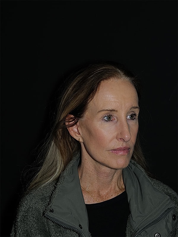 Facelift Neck Lift Before & After
