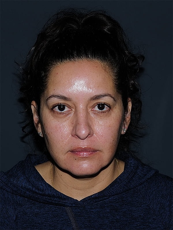 Facelift Neck Lift Before & After