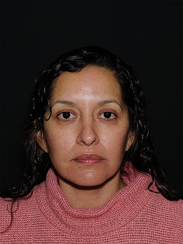 Facelift Neck Lift Before & After
