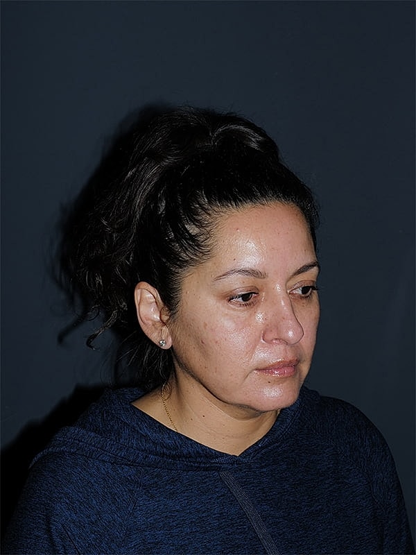 Facelift Neck Lift Before & After