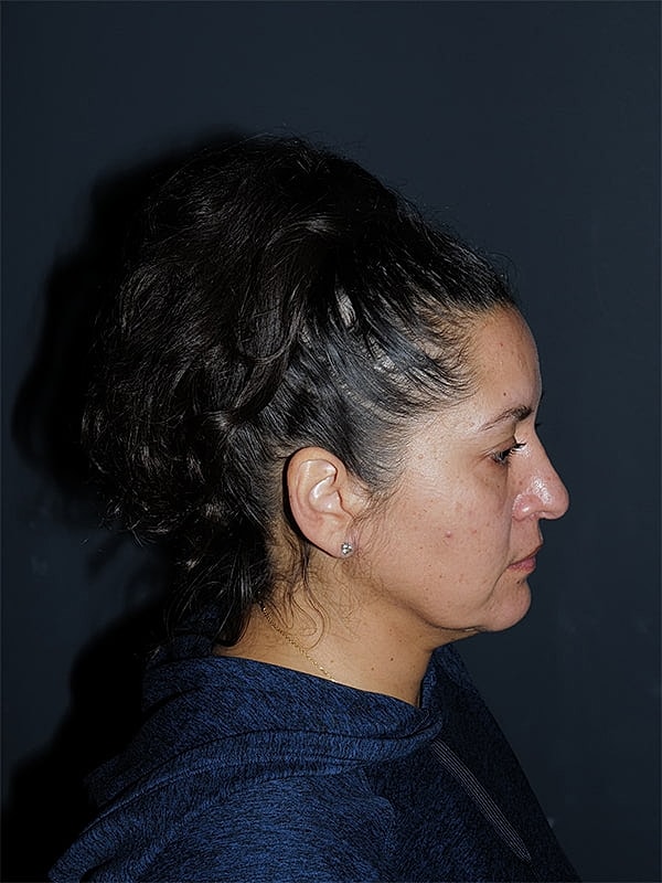 Facelift Neck Lift Before & After