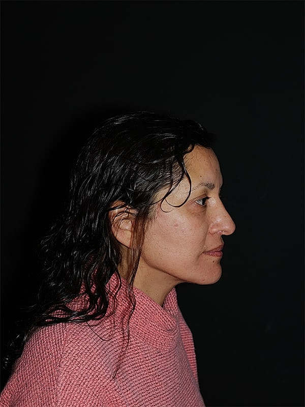 Facelift Neck Lift Before & After