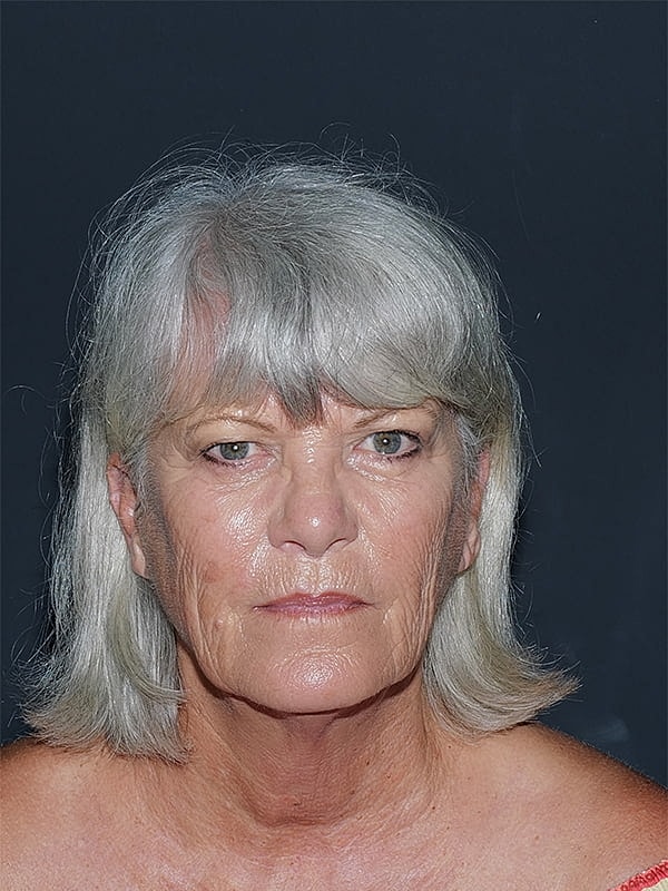 Facelift Neck Lift Before & After
