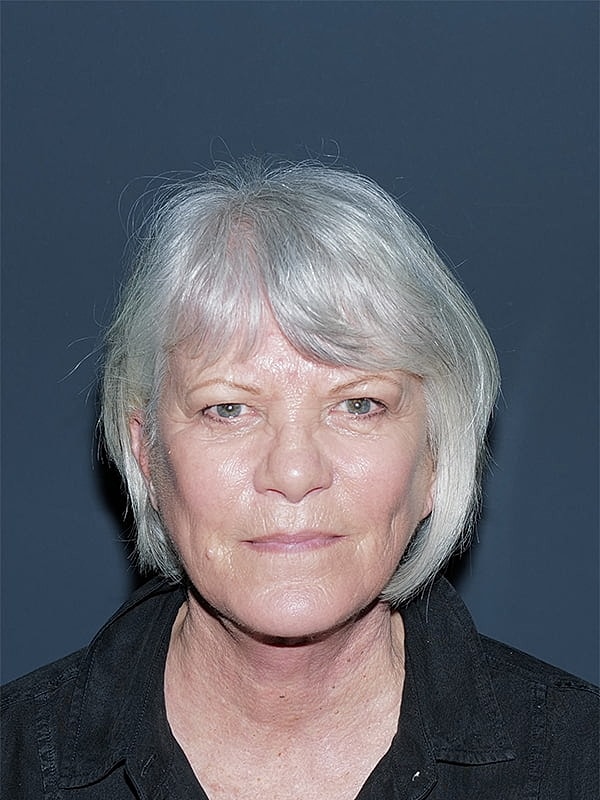 Facelift Neck Lift Before & After