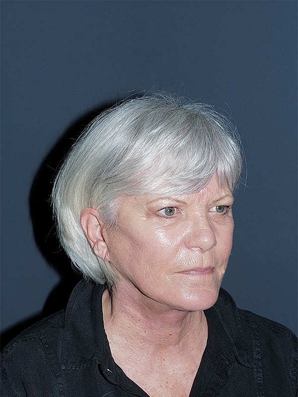 Facelift Neck Lift Before & After
