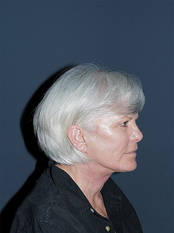 Facelift Neck Lift Before & After