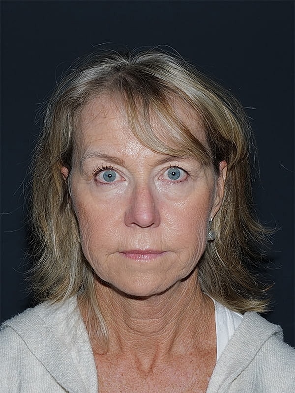 Facelift Neck Lift Before & After