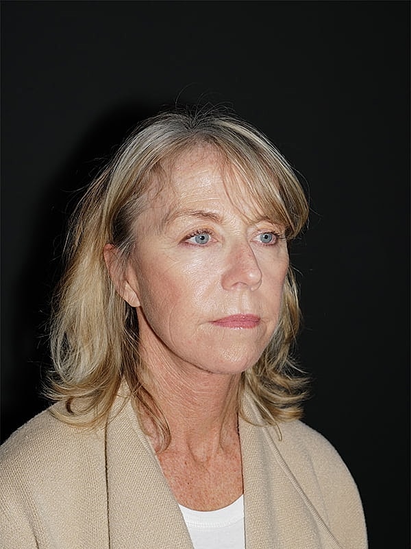 Facelift Neck Lift Before & After
